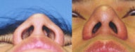Asian Rhinoplasty
