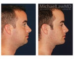 Liposuction