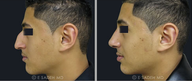 Nose Surgery