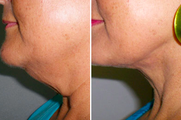 SmartLipo