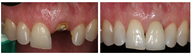 Single Tooth Dental Implant