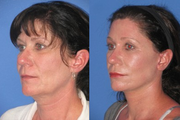 Brow Lift