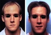 Hair replacement with Fleming/Mayer flap