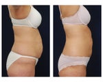 Liposuction