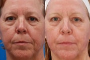 Laser Resurfacing Before & After