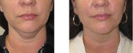 Chin liposuction/Liposculpture