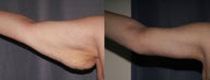 Arm Lift (Brachioplasty)