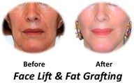 Facelift, fat transfer, skin resurfacing