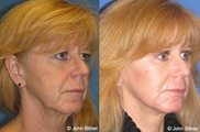 Brow Lift