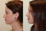 Rhinoplasty Surgery with left spreader graft. 7-months post-op.
