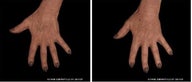 Fraxel and Fillers for Hand Rejuvenation