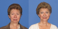 Brow Lift