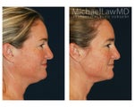 Liposuction