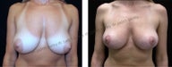 Breast Lift