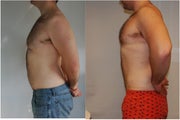 Male Before and After Lipo Chest and Abdomen