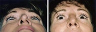 Before and after septoplatsy
