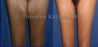 Thigh Lift after massive weight loss