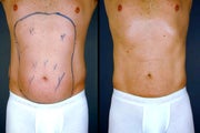 Pure Tumescent Liposuction