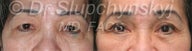 Upper Eyelid Lift