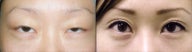 Upper Blepharoplasty