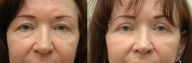 Upper & Lower Eyelid Surgery