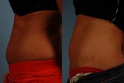 Trusculpt- one treatment