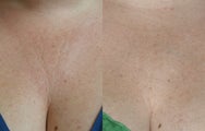 Sculptra Before and After
