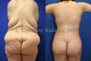 Torso Back Reduction