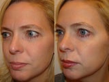 Female treated for glabella, forehead and crows feet