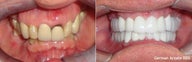 56 y/o male from Georgia had a complete smile makeover with porcelain bridges & crowns.