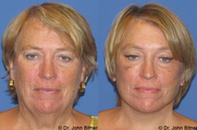 Brow Lift