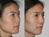 Asian Rhinoplasty