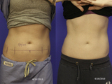 CoolSculpting
