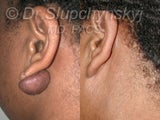 Earlobe Keloid