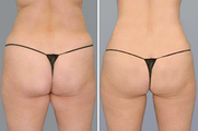 SmartLipo