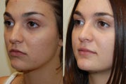 Rhinoplasty Surgery. 2 months post-op.