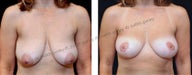 Breast Lift
