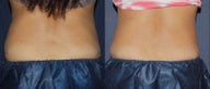Before & After CoolSculpting
