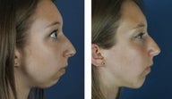 Female Chin Implant
