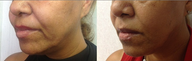 Perlane Before and After Photo