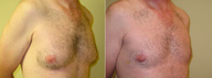 Breast Reduction
