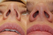 Revision Rhinoplasty Surgery. 8 months post-op.