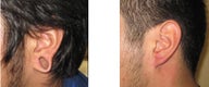 gauge earlobe repair, earlobe reconstruction