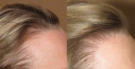 Female hair restoration FUE
