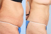 Smart Lipo: Abdomen