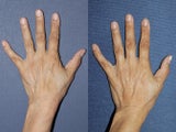 Sclerotherapy For Hand Veins