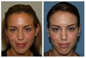Otoplasty