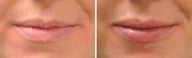 Lip Augmentation