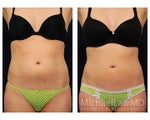 Liposuction