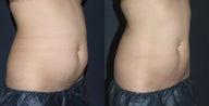 Before & After CoolSculpting